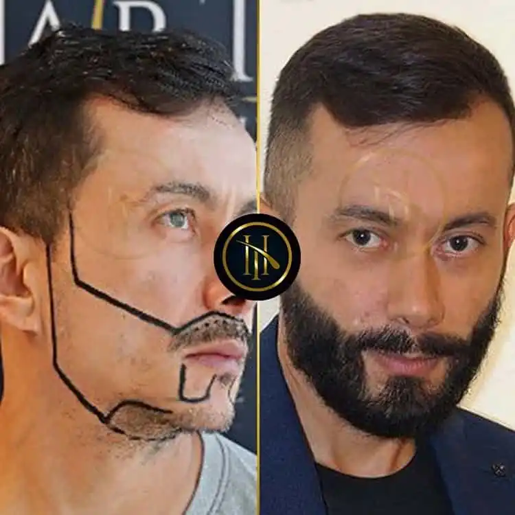 beard transplant before after