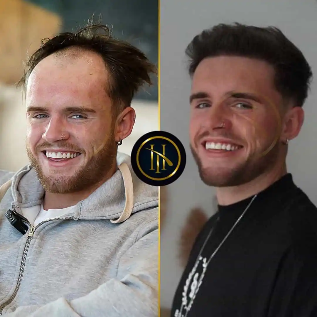 Hair transplant without shaved